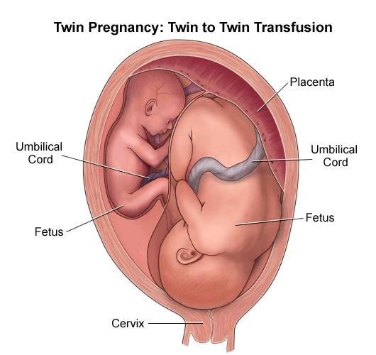 Twin To Twin Transfusion