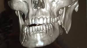 X Ray Of A Broken Jaw