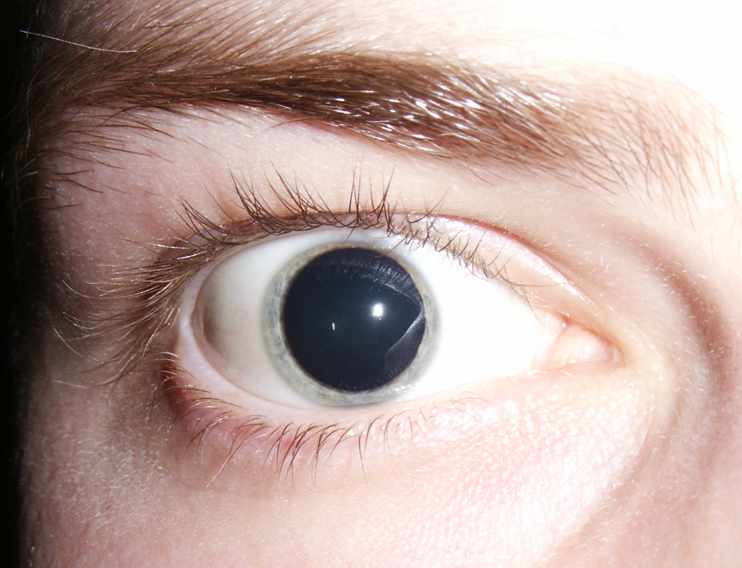 Dilated Pupil