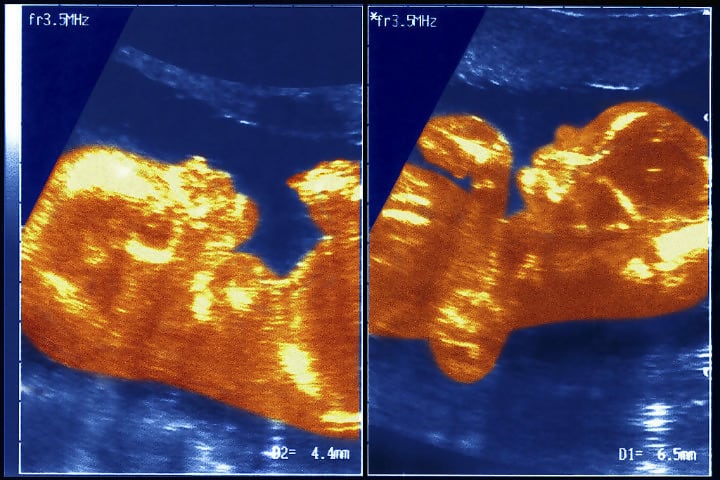 Ultrasound Photos Of The Twin Girls