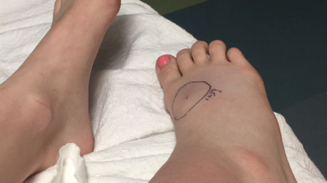 Kamri Thompson's Swollen Foot