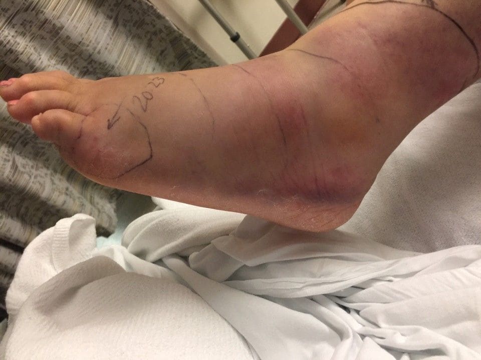 Angie's Foot Swelling Up