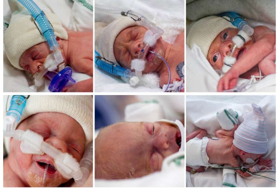 The Perkins Sextuplets In Nicu