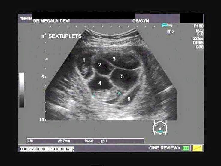 The Ultrasound Of The Perkins Sextuplets